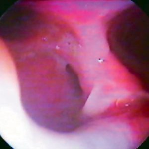 Fistula Traqueobroncoesofágica