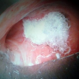 Fistula Bronquial