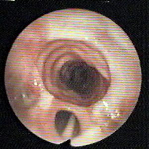 Fistula Traqueal