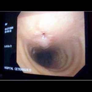 Fistula Traqueal