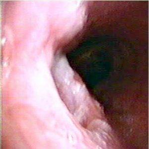 Fistula Traqueal