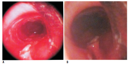 Figura 3. (a y b): Reconstrucción de la luz y endoscopia control