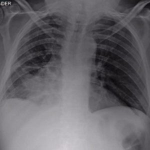 Stent Bronquial