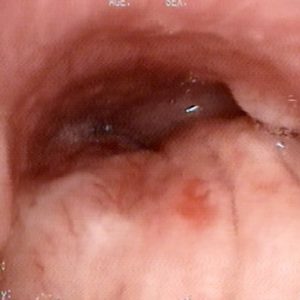 Tumor Bronquial
