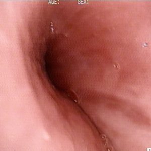 Estenosis Bronquial «Infundibuliforme»