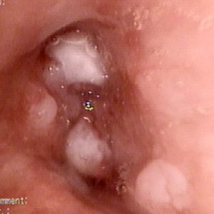 Carcinoma Bronquial