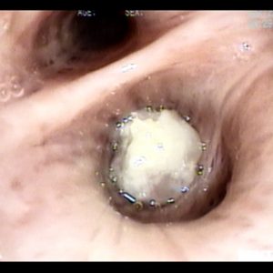 Tumor de Superficie Necrótica