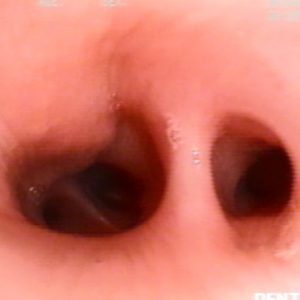 Tumor Intramural