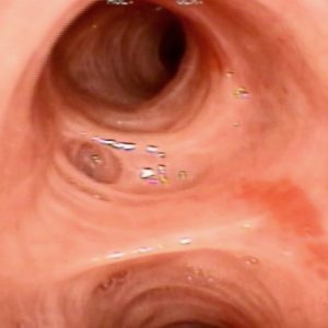 Atrofia Mucosa