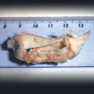 Pseudomembrana Traqueal