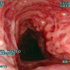 Traqueopatía Osteocondroplástica
