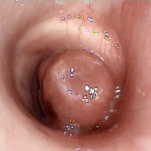 Tumor Traqueal