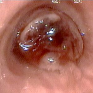 Tumor Traqueal