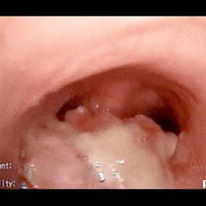 Tumor Traqueal