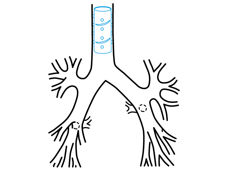 Esquema de uso sugerido do Stening® Helicoidal na árvore traqueal