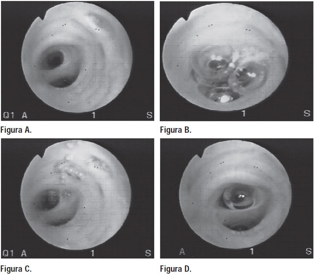 Figuras A, B, C y D — signo de la burbuja en broncoscopía