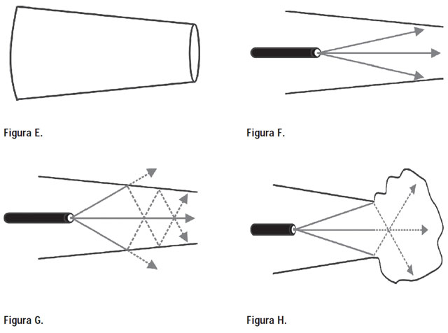 Figuras E, F, G y H — fisiopatología del signo del agujero negro
