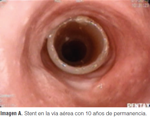 Stent en la vía aérea con 10 años de permanencia