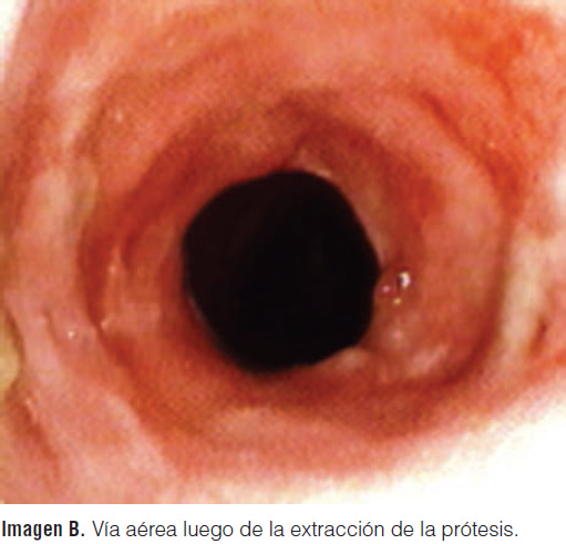 Vía aérea luego de la extracción de la prótesis