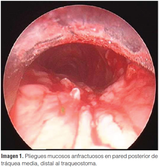 Pliegues y surcos longitudinales en la pared traqueal posterior